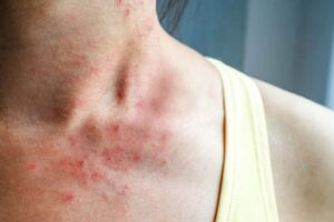 Tại Sao Người Nghiện Ma Túy Lại Sợ Nước? 5 Chăm sóc y tế và điều trị các bệnh ngoài da