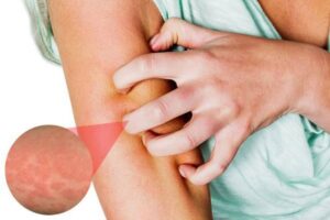 Cách kiểm soát và điều trị phát ban HIV