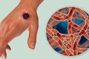 HIV có lây qua vết xước nhỏ không? Giải đáp chính xác từ chuyên gia 3 Cơ chế HIV lây truyền qua vết thương