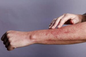 Đặc điểm chung của phát ban HIV