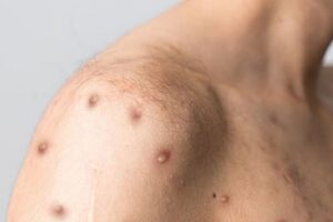 Triệu chứng HIV Dấu hiệu nhận biết sớm và giai đoạn tiến triển 3 Giai đoạn 3 Giai đoạn AIDS (suy giảm miễn dịch nghiêm trọng)