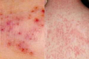 Phân biệt phát ban HIV với các loại phát ban thông thường