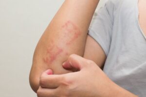 Phát ban HIV có ngứa không