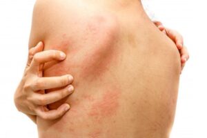 Tổng quan về phát ban HIV