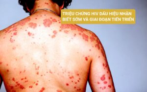 Triệu chứng HIV Dấu hiệu nhận biết sớm và giai đoạn tiến triển